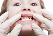 Carie precoce della prima infanzia