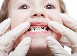 Carie precoce della prima infanzia